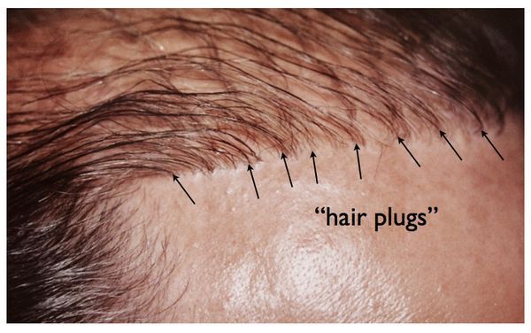 Bad Hair Plugs For Men