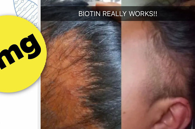 Biotin Shampoo Hair Growth Results Before And After