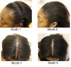 Black Castor Oil For Hair Growth Before And After