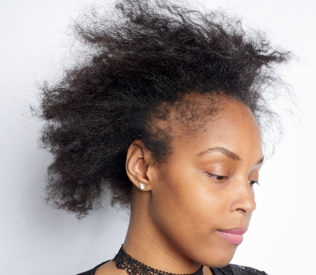 Black Female Hair Loss Treatment